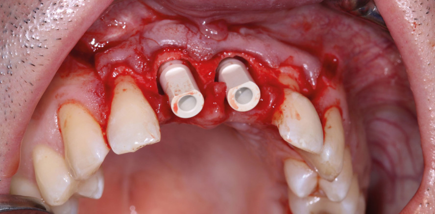 Rehabilitation der ästhetischen Zone mit Keramikimplantaten