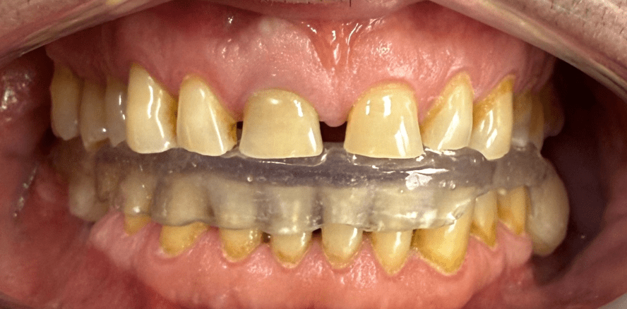 Ästhetische und funktionelle Rehabilitation mit Multilayer-Zirkonkronen