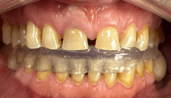 Ästhetische und funktionelle Rehabilitation mit Multilayer-Zirkonkronen