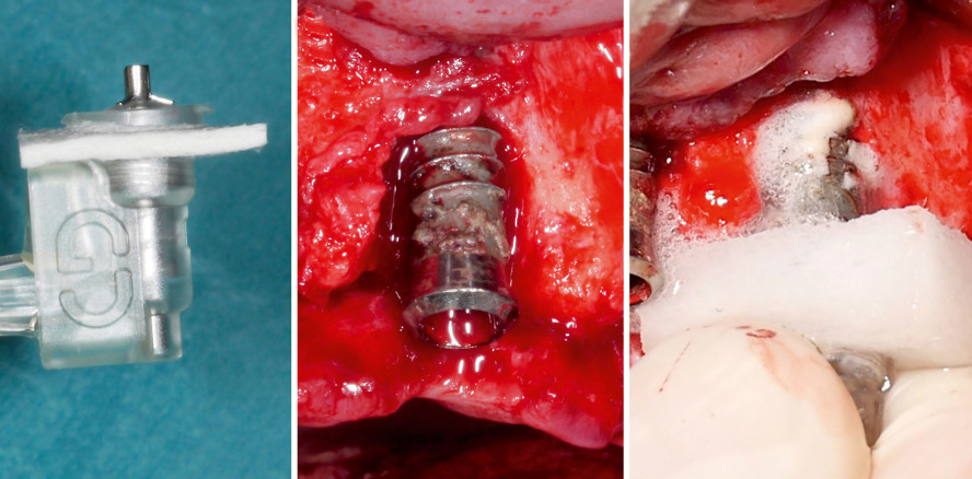 Resektive Periimplantitistherapie – Indikation und Herausforderungen
