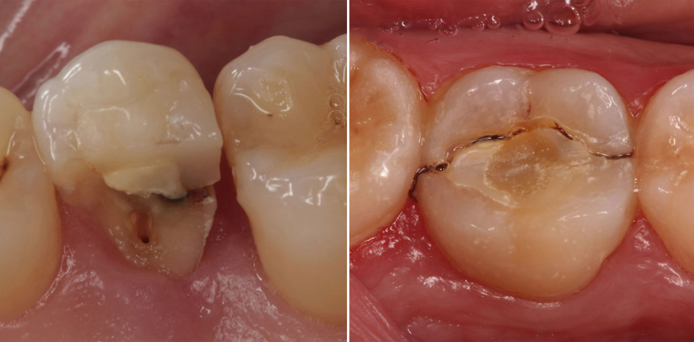 Optimale Restauration nach endodontischer Behandlung