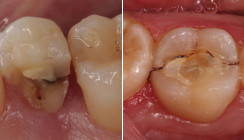 Optimale Restauration nach endodontischer Behandlung