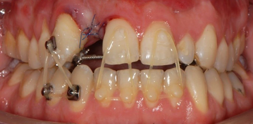 Restaurative Zahnheilkunde als Teil eines interdisziplinären Behandlungskonzepts