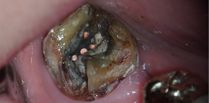 Revisionsbehandlung eines Molaren mit komplexer Anatomie