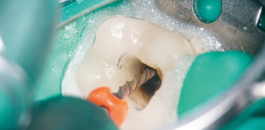 Revision trägerbasierter Wurzelfüllung