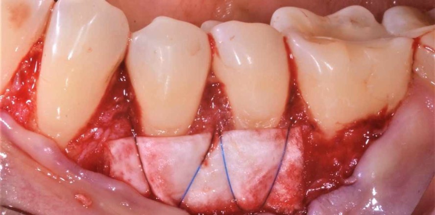 Multiple Rezessionsdeckungen mit Kollagenmembran