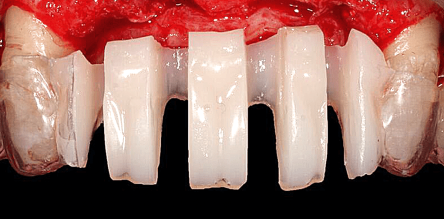 Frontzahnbereich: Risikoabwägung bei Sofort- und Spätimplantation