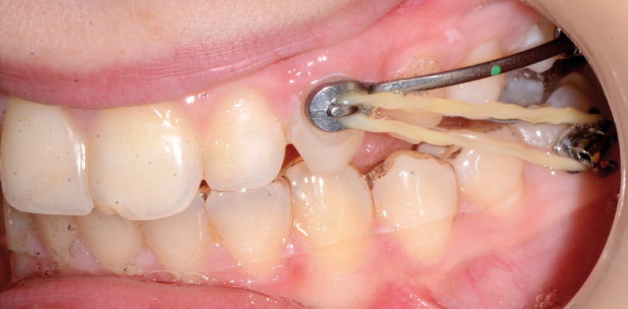 Sagittal First™ bei der Klasse  II-Korrektur