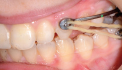 Sagittal First™ bei der Klasse  II-Korrektur