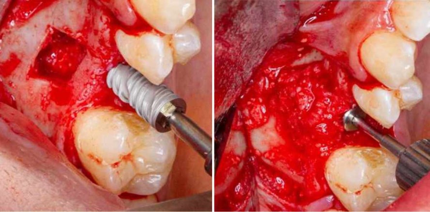 Sinusaugmentation und Implantatinsertion in Sandwich-Technik