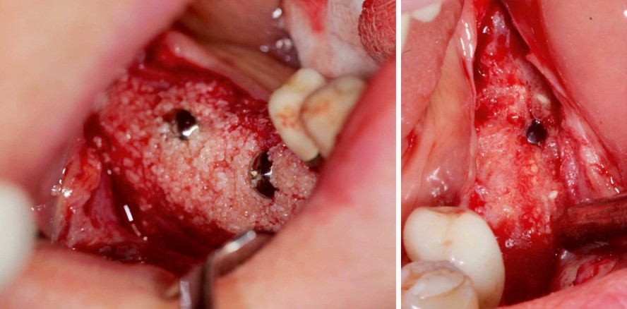 Sanierung des zahnlosen posterioren Unterkiefers