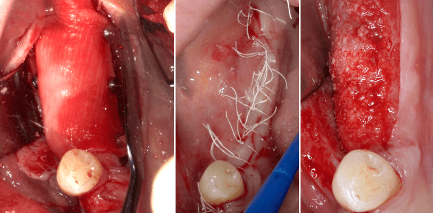 Sausage Technique – vorhersagbar horizontal augmentieren