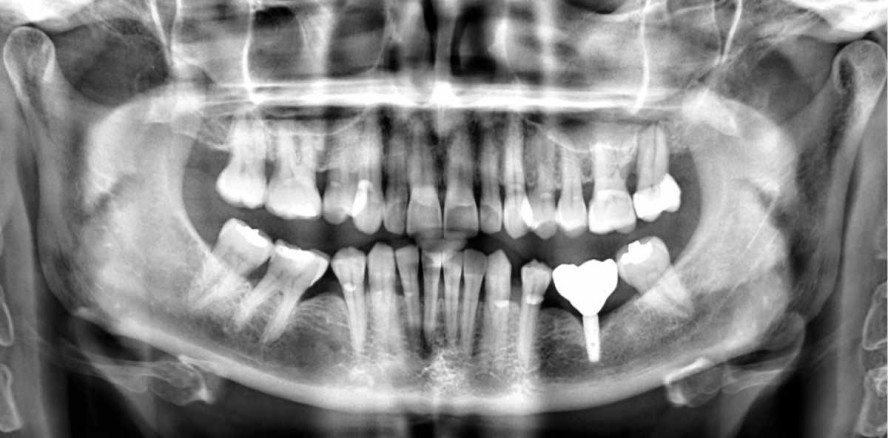 Schablonengeführte Chirurgie bei geringem Knochenangebot
