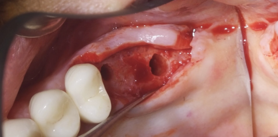 Sinusbodenaugmentation mit Osseodensification-Technik