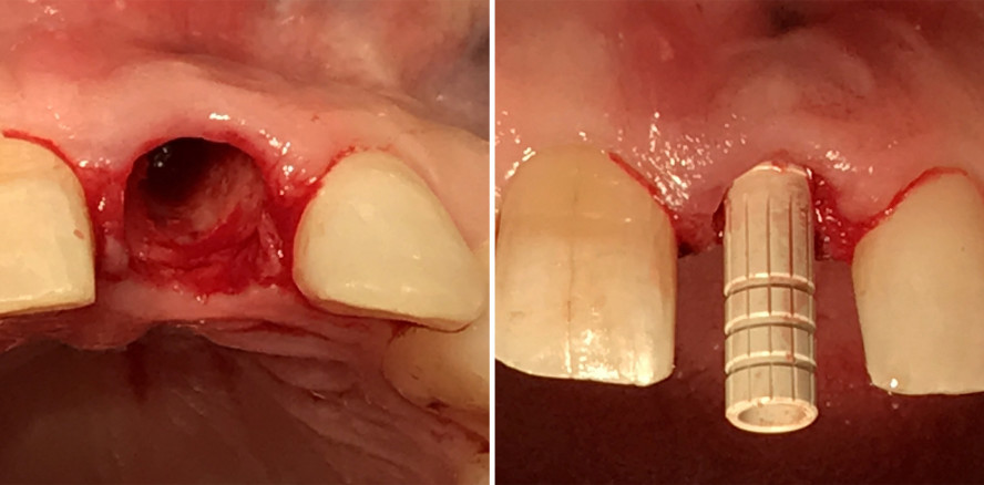 Sofortimplantate in Extraktionsalveolen mit synthetischem Kitt-Transplantat