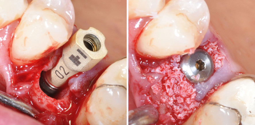 Implantatprothetik: Sofortimplantation digital umgesetzt