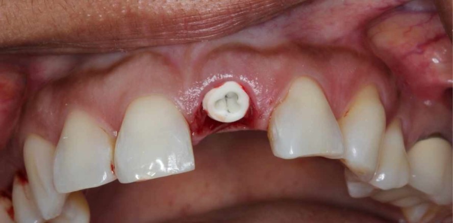 Sofortinsertion und Sofortbelastung eines Keramikimplantats