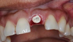 Sofortinsertion und Sofortbelastung eines Keramikimplantats