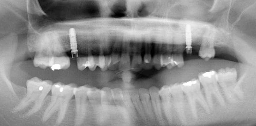 Spätimplantation nach beidseitiger Sinusbodenelevation