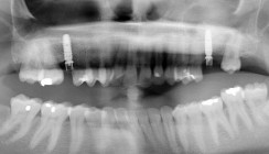 Spätimplantation nach beidseitiger Sinusbodenelevation