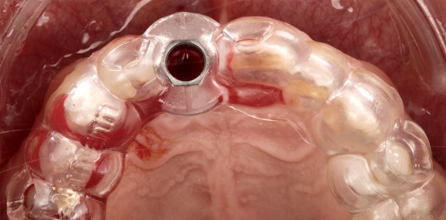 Strukturerhalt nach Frontzahn­implantat infolge Kronenfraktur