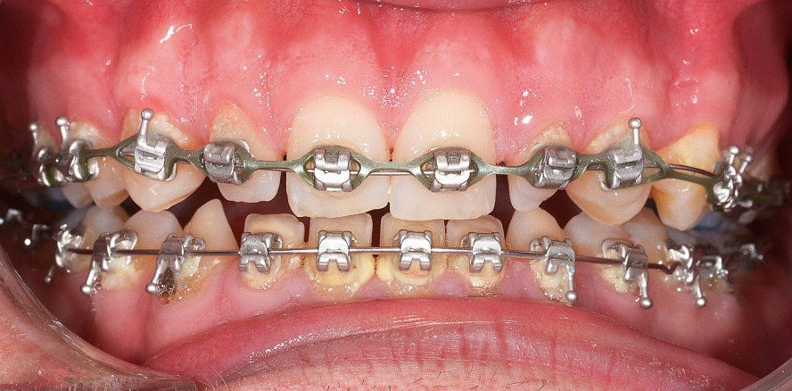 Aligner und Brackets: Hybride Behandlung komplexer Fehlstellungen