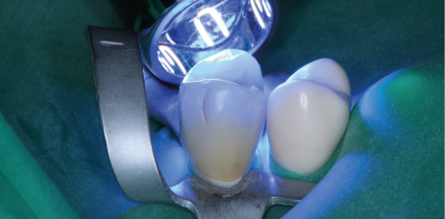 Einzelzahnkronen aus CAD/CAM-Kompositen – Teil 2