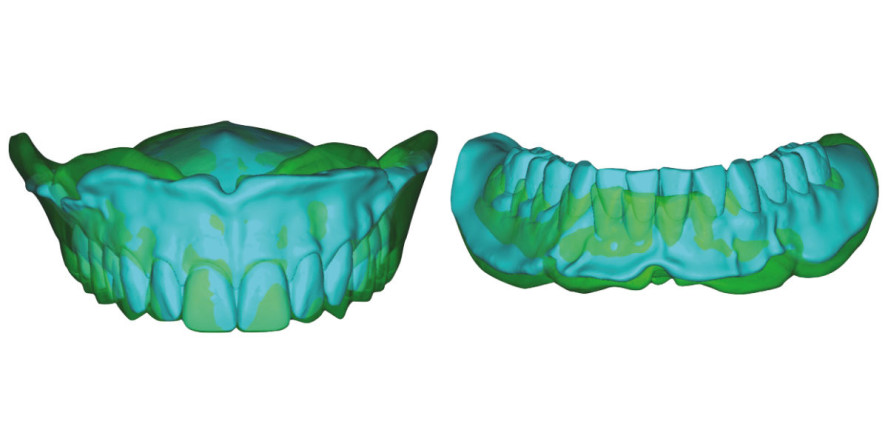 Konventionell vs. digital: Vergleich bei der Herstellung einer Totalprothese