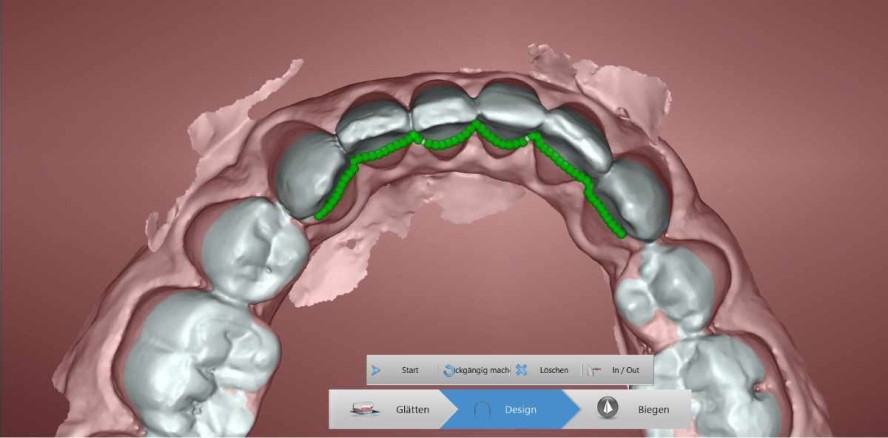 Digitale indirekte Herstellung festsitzender UK-Retainer