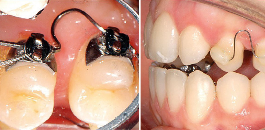 KFO-Lückenmanagement bei schwierigen Verankerungssituationen