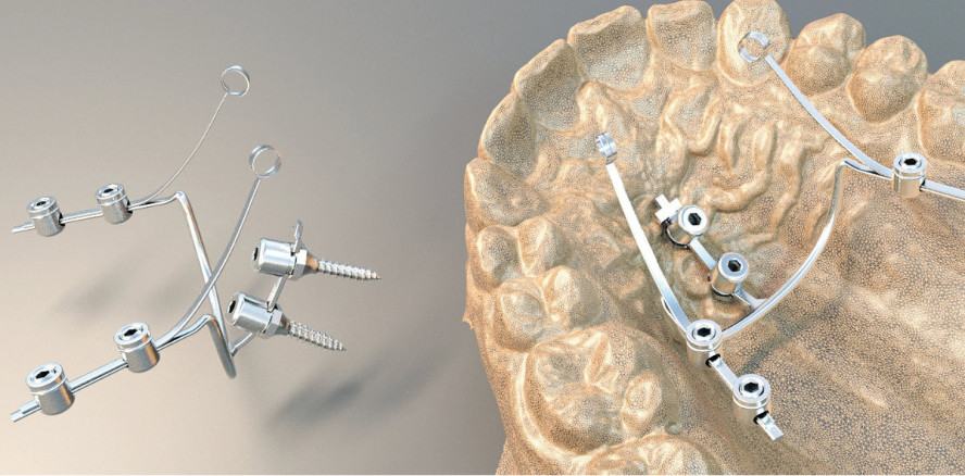 Einstellung verlagerter Zähne mit skelettal verankerter TMA-Feder