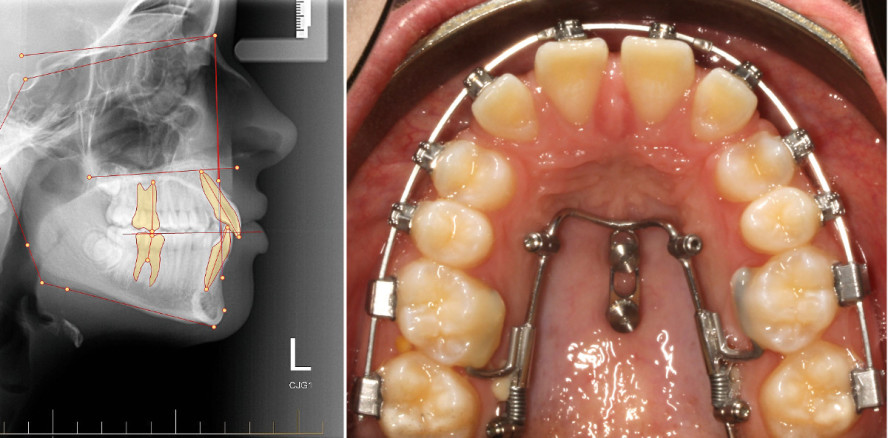 Effektiver Lückenschluss im Oberkiefer