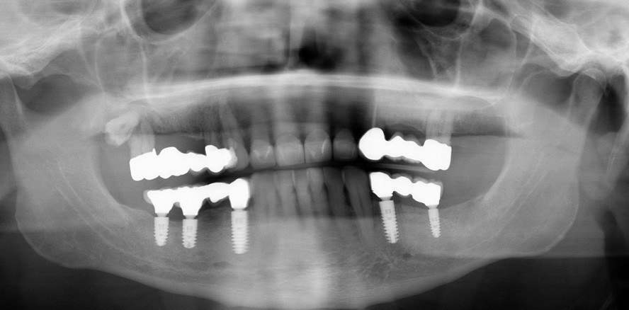 Implantatabformung – Basis zahntechnischer Implantatprothetik