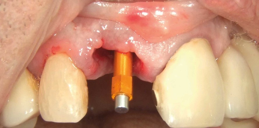 „The perfect screw“ bei älteren Patienten (Teil 3)
