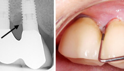Prävention als die effektivste „Therapie“ periimplantärer Erkrankungen