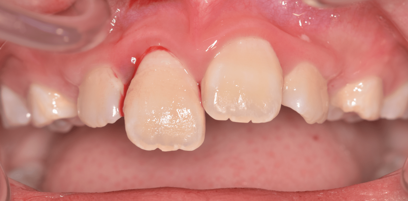 Pulpadiagnostik und -therapie nach Zahntrauma