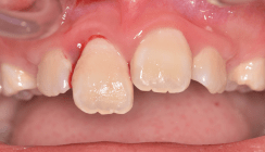 Pulpadiagnostik und -therapie nach Zahntrauma