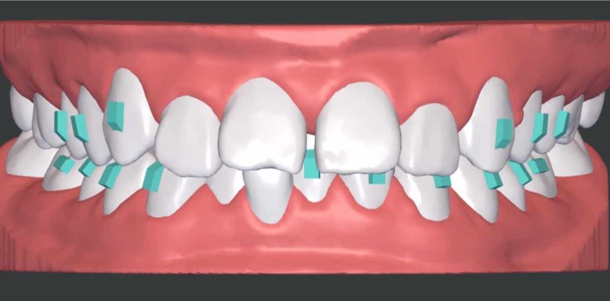 Tiefbisskorrektur mithilfe eines Alignersystems