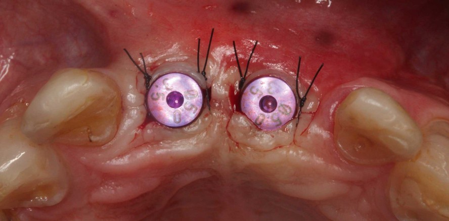 Tooth Shell Technique: Ästhetische Kieferkammrekonstruktion