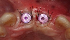 Tooth Shell Technique: Ästhetische Kieferkammrekonstruktion