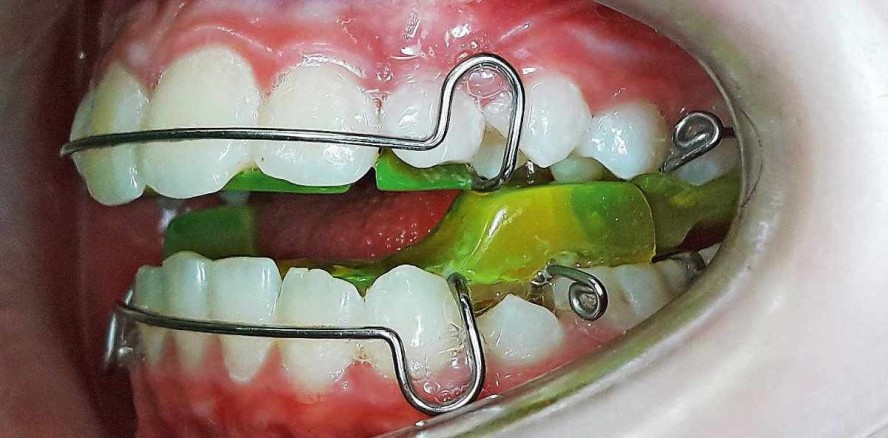 Korrektes Trimmen von Twin-Block-Aufbissen