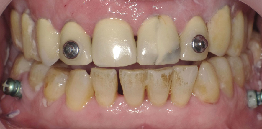 Umstellungsosteotomie ohne Kieferorthopädie sinnvoll?