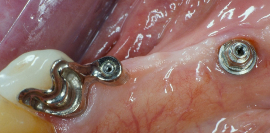 Verbundbrücke – Alternative zum implantatgetragenen Zahnersatz?