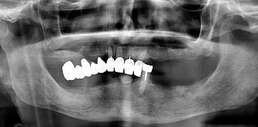 Verschraubte bimaxilläre Full-Arch-Versorgung