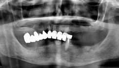 Verschraubte bimaxilläre Full-Arch-Versorgung