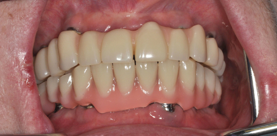 Implantatprothetische Versorgung bei Sjögren-Syndrom