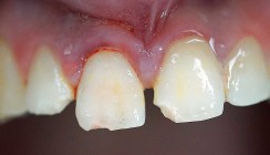 Versorgung eines Frontzahntraumas in Verbindung mit Alveolarfortsatzfraktur
