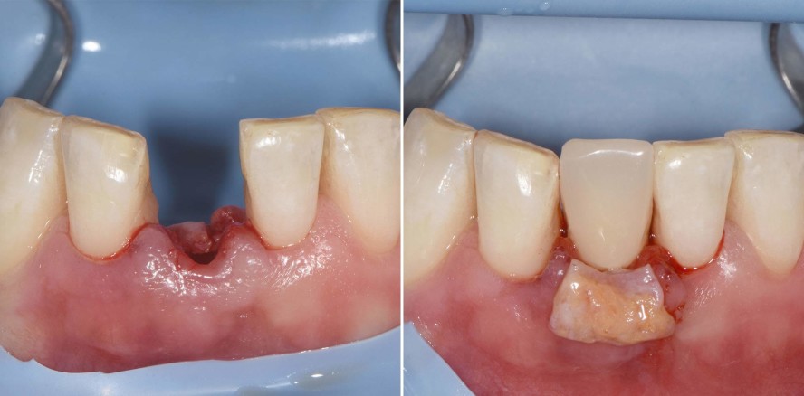 Sofortimplantat und Funktion in der ästhetischen Zone