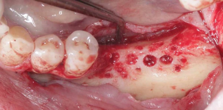 Mehr Sicherheit bei vertikalen Knochenaugmentationen