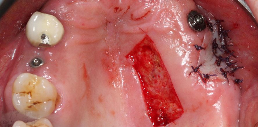 Vestibulumplastik als Schnittstelle zwischen Chirurgie und Prothetik